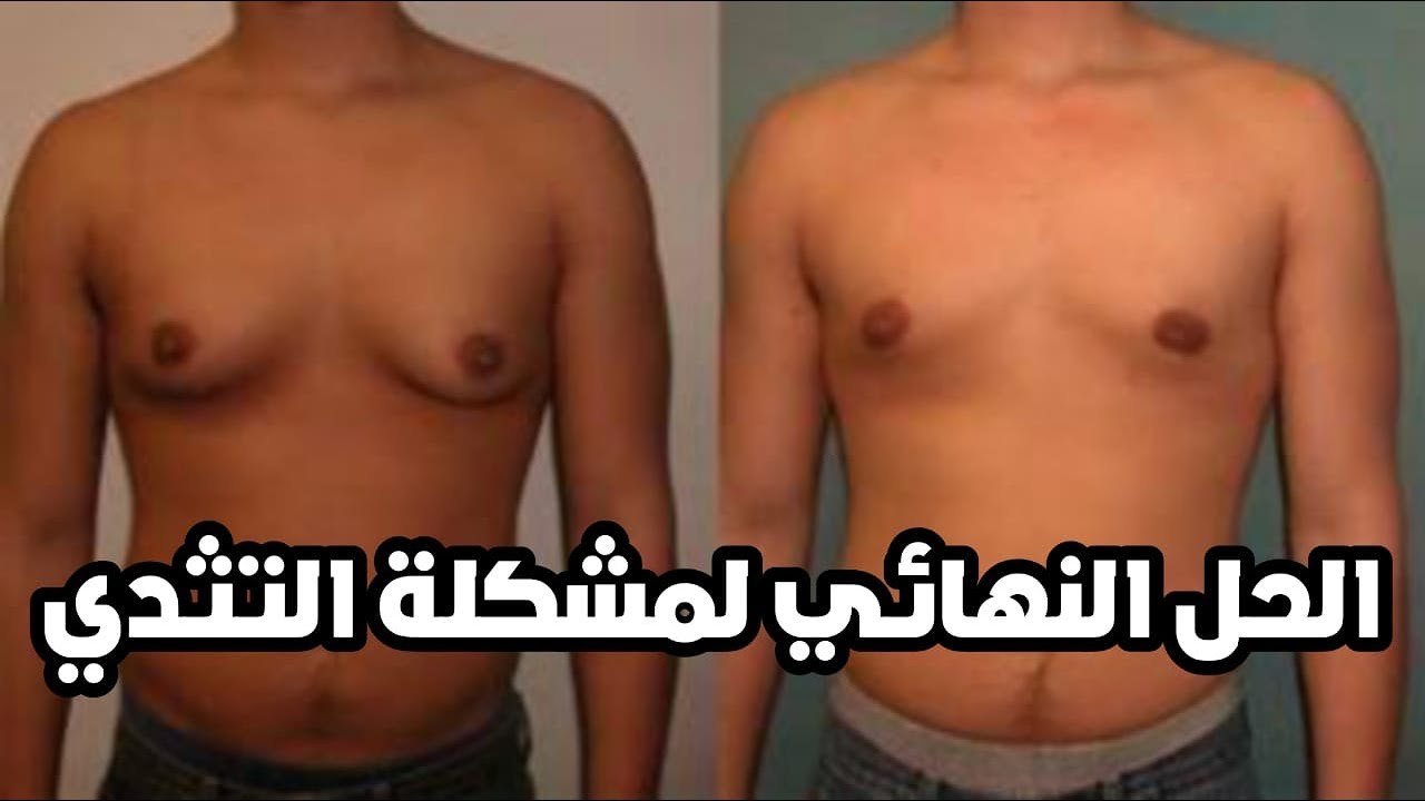 التثدي عند الرجال - الاسباب وطريقة العلاج