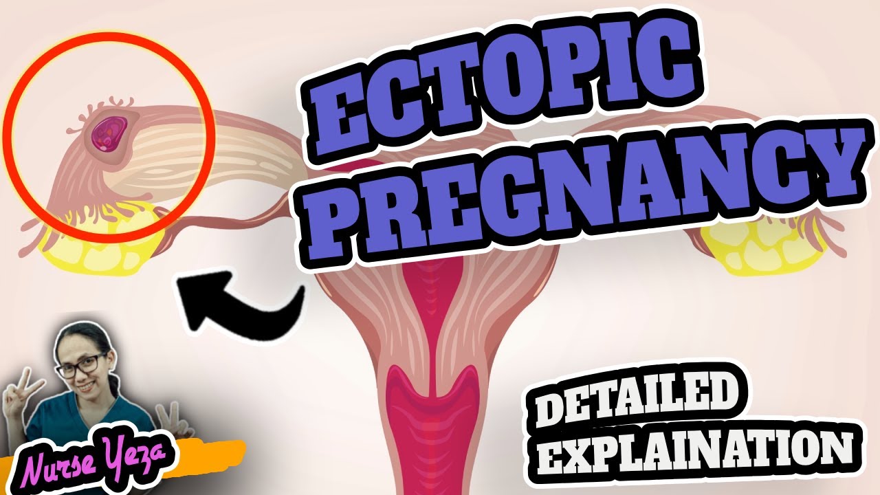 ECTOPIC PREGNANCY | MABUBUNTIS PA BA?