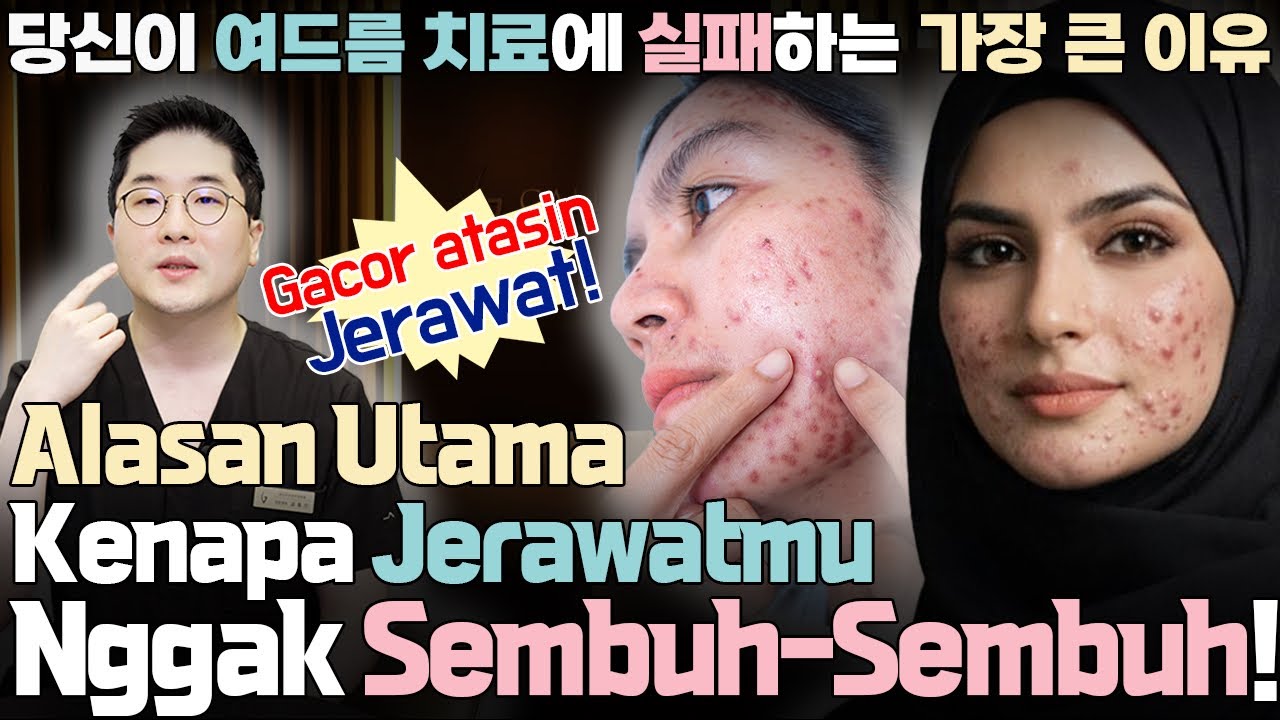 Berhenti Buang-Buang Waktu, Tonton Video Ini biar Tahu Alasan Kenapa Jerawatmu Nggak Sembuh-Sembuh!