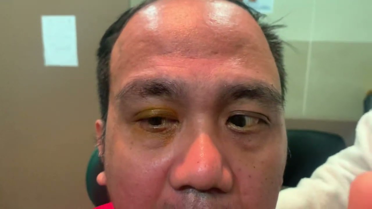 Left Horizontal Gaze Palsy (Pontine Stroke)