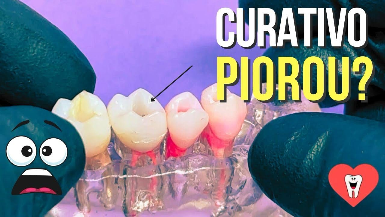 PULPITE IRREVERS&Iacute;VEL: ENDODONTIA SEM COMPLICA&Ccedil;&Atilde;O - Endolovers