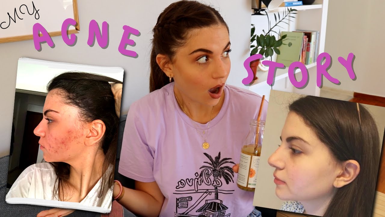 Η ΙΣΤΟΡΙΑ ΜΟΥ ΜΕ ΤΗΝ ΑΚΜΗ 😱