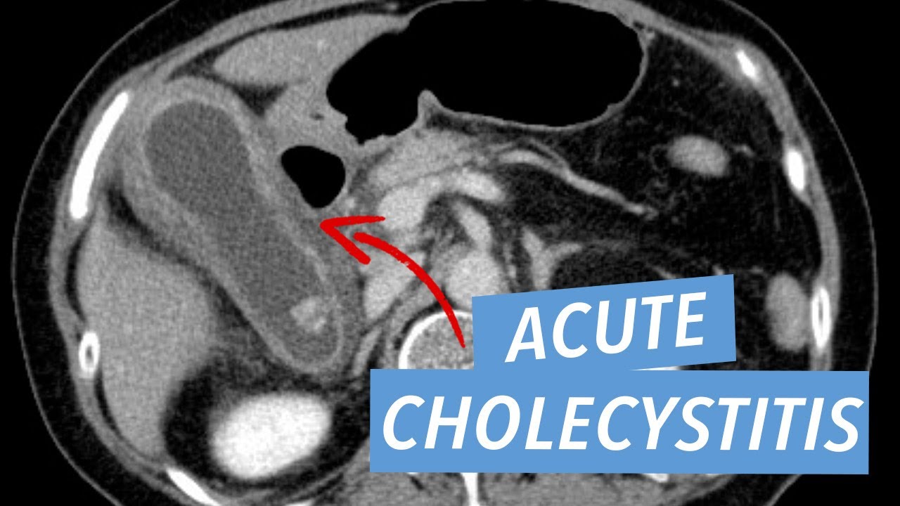 Acute Cholecystitis on CT and Ultrasound
