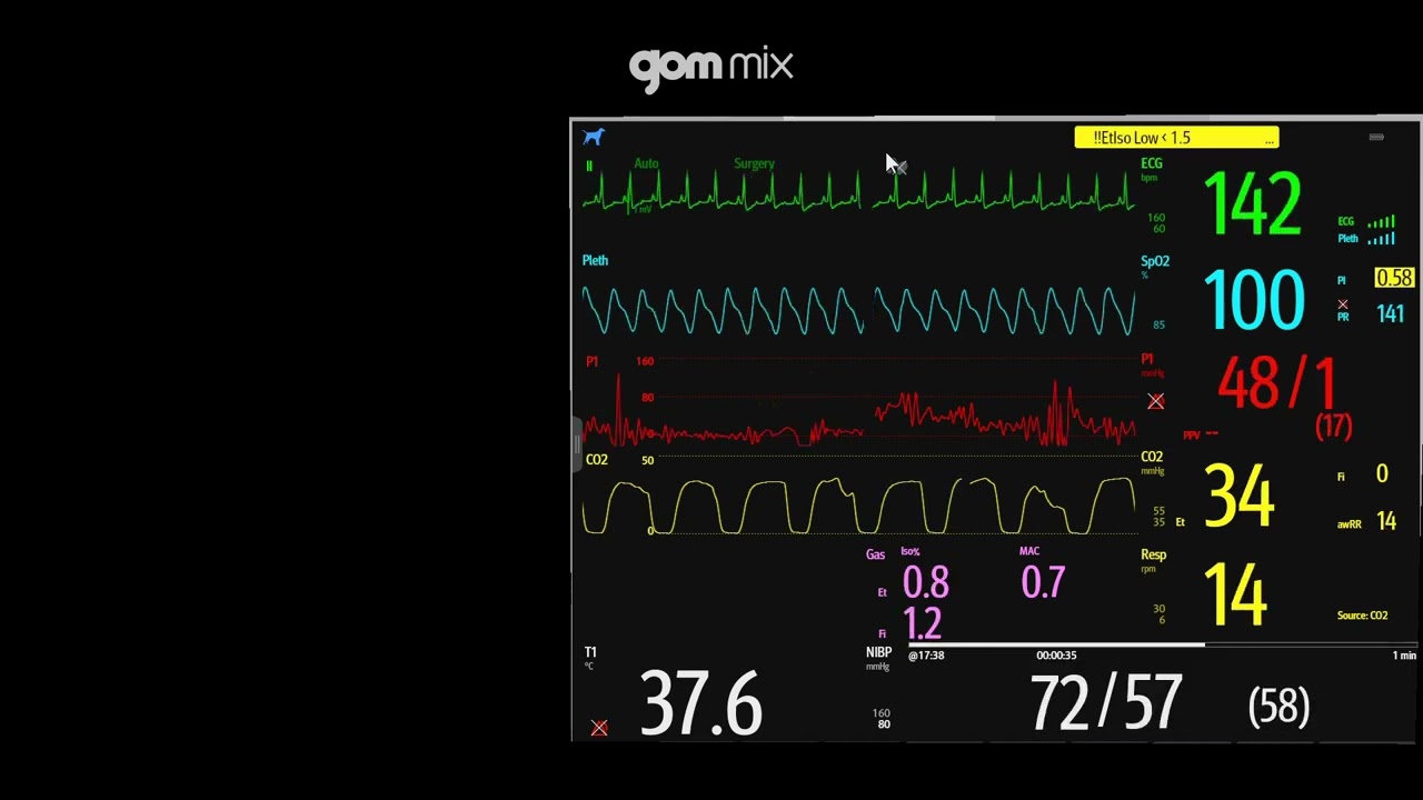 Intraoperative Vital Sign Changes During Cholecystectomy