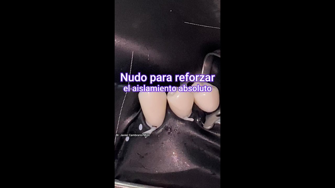 Nudo para reforzar aislamiento absoluto | Alternativa al Wedjet