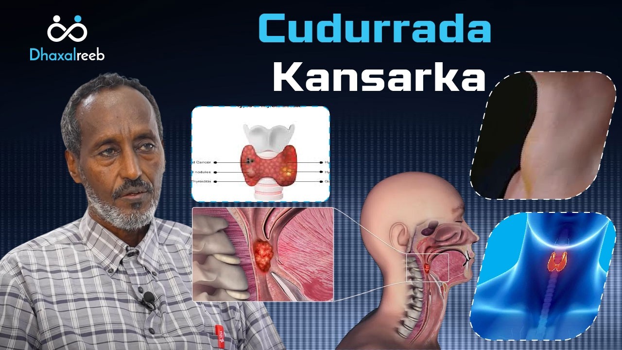 Waraysi Cudurrada Kansarka | Dr. Xuseen Abshir Xasan.