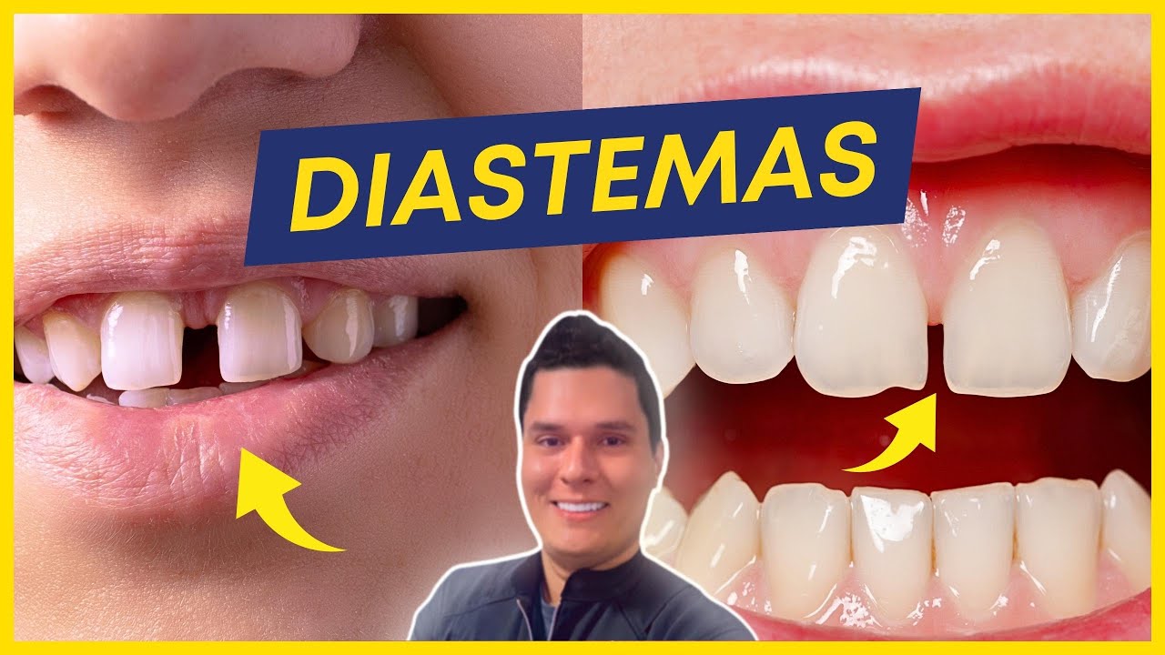 DIASTEMAS - POR QUE ACONTECEM? COMO RESOLVER?