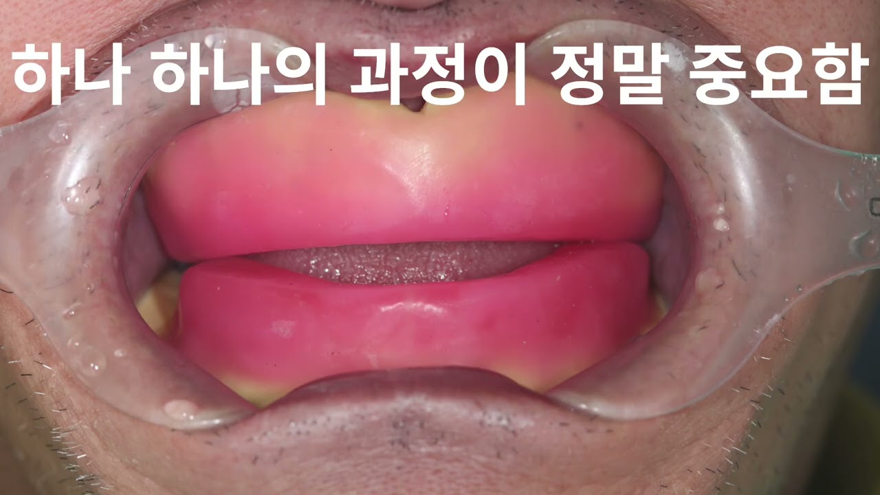완전틀니치료