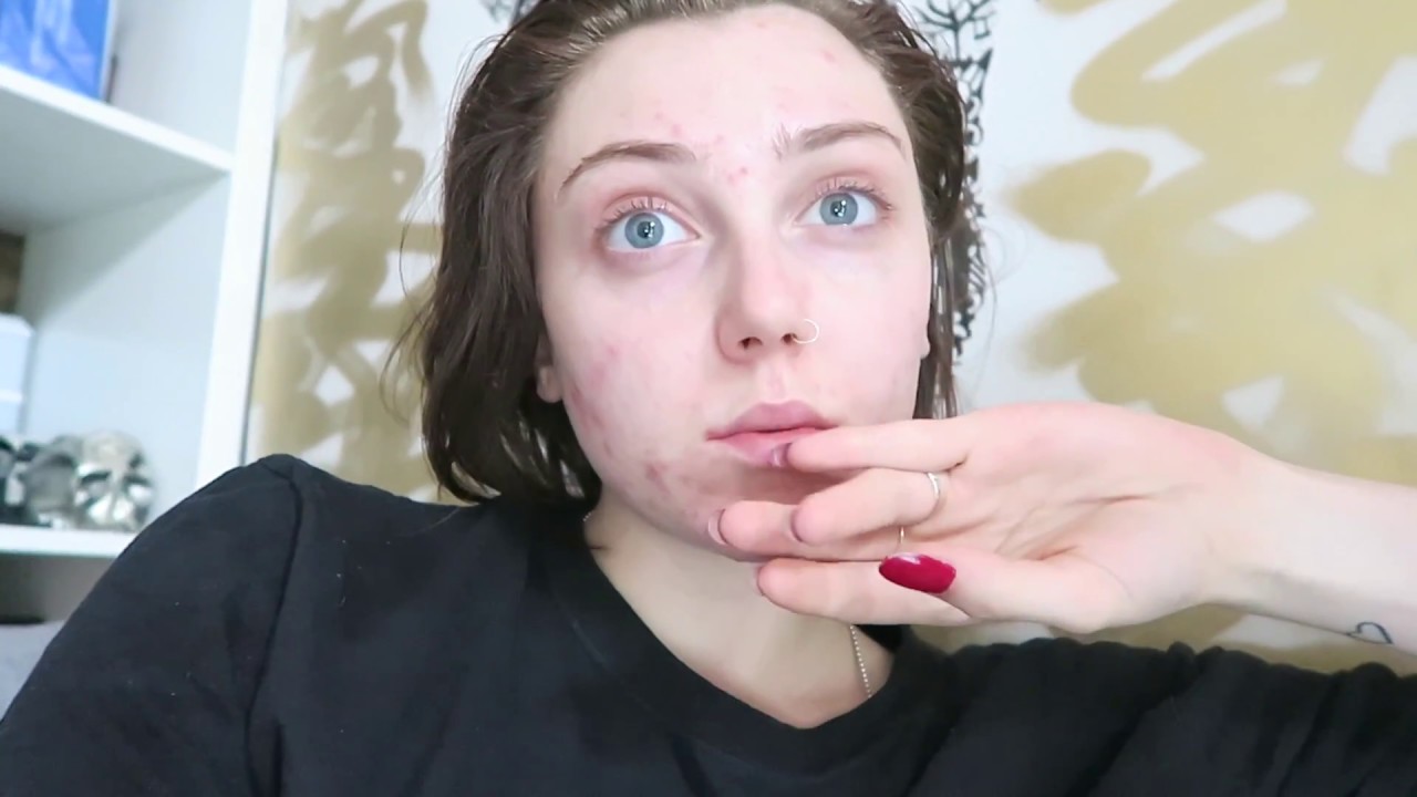 My Acne Journey - polycystic ovaries, veganism, antibiotics, no confidence, insecurity, pain etc