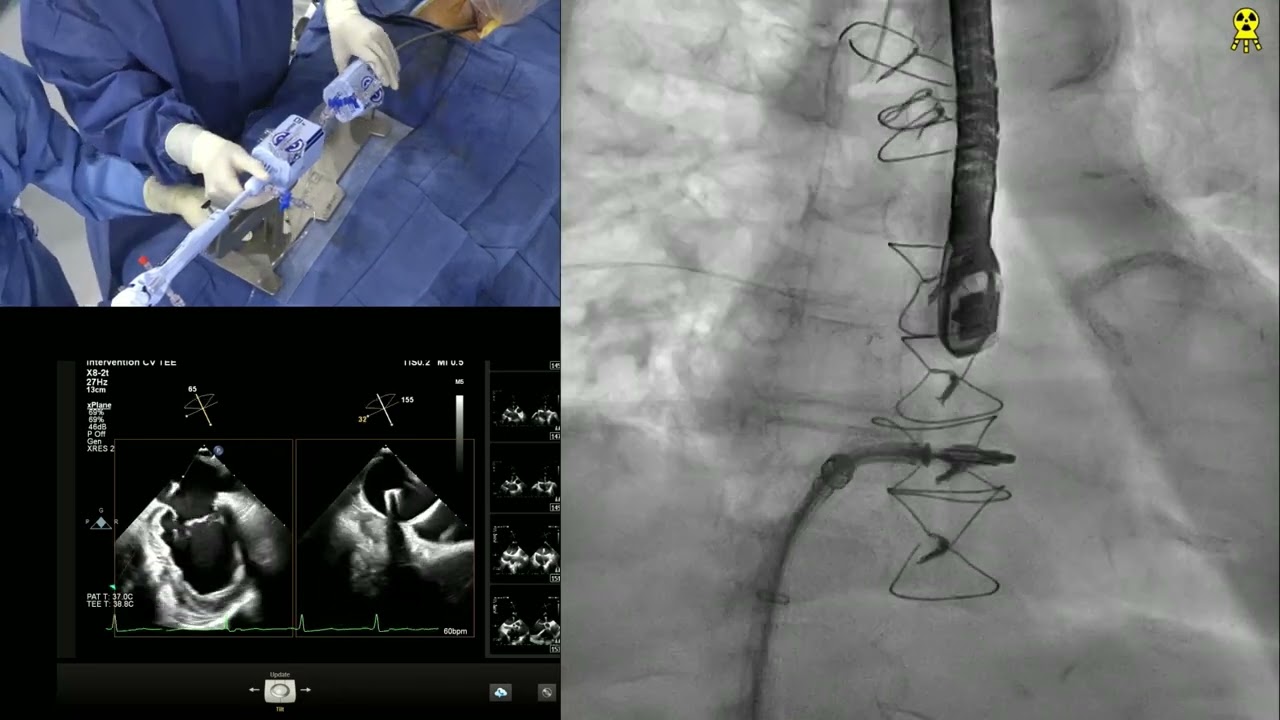 LIVE CASE 4 - FUNCTIONAL MR TEER