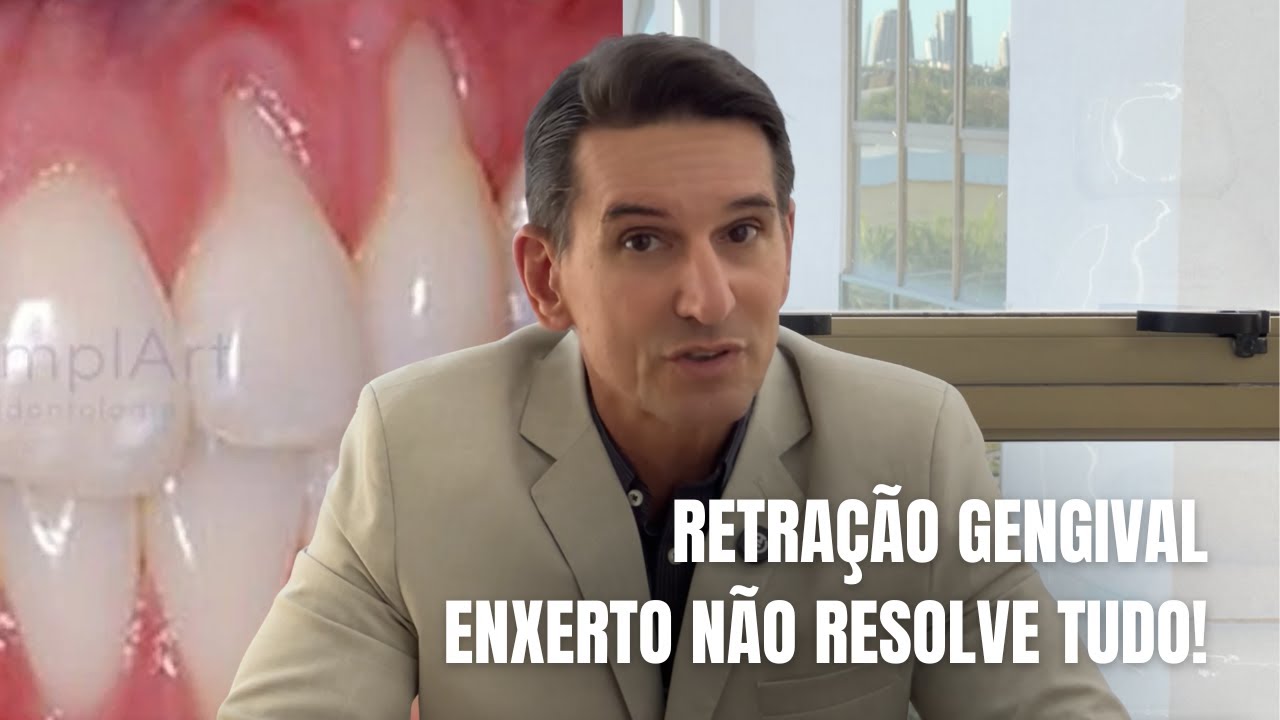 Retração gengival: quando tratar e quando NÃO adianta operar!