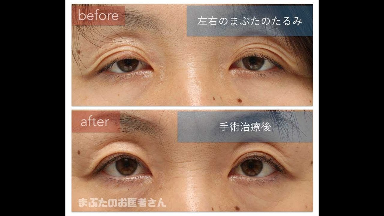 眼瞼下垂症の手術をして１年経過。まぶたの動きを見てみましょう