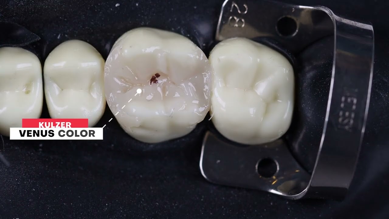 Class II MOD Direct Composite Restoration Technique
