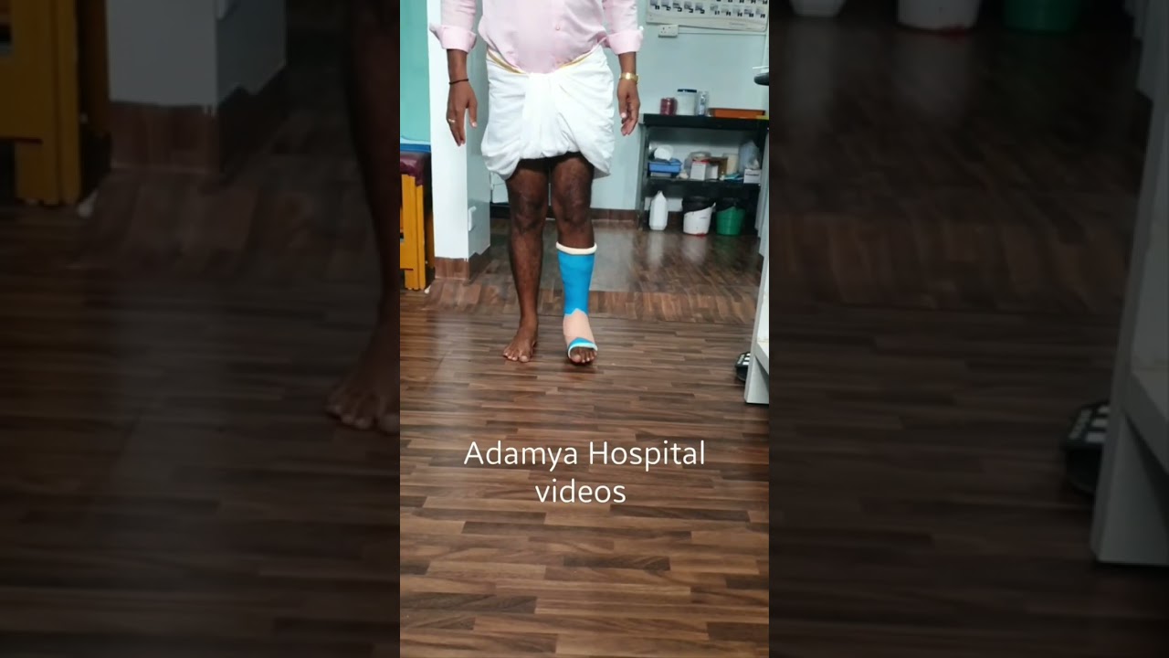 Jone's avulsion fracture | 5th Metatarsal base fracture | Conservative Fiberglass Plstr | Adamya H V