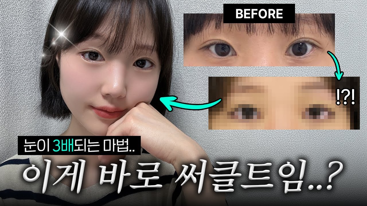 눈이 3배가 되..🪄써클트임으로 청순 귀염상 된 뒤밑트임 찐 후기