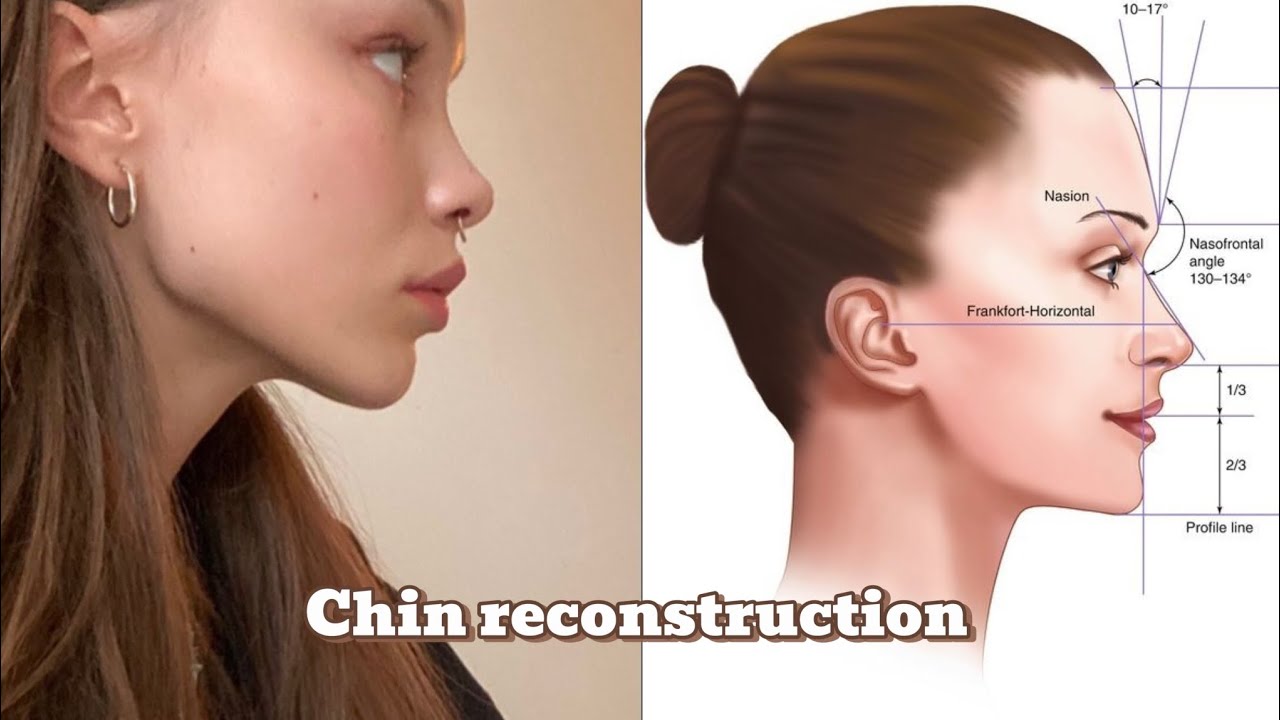 Chin reconstruction (Forward pulled fully grown chin  Subliminal )
