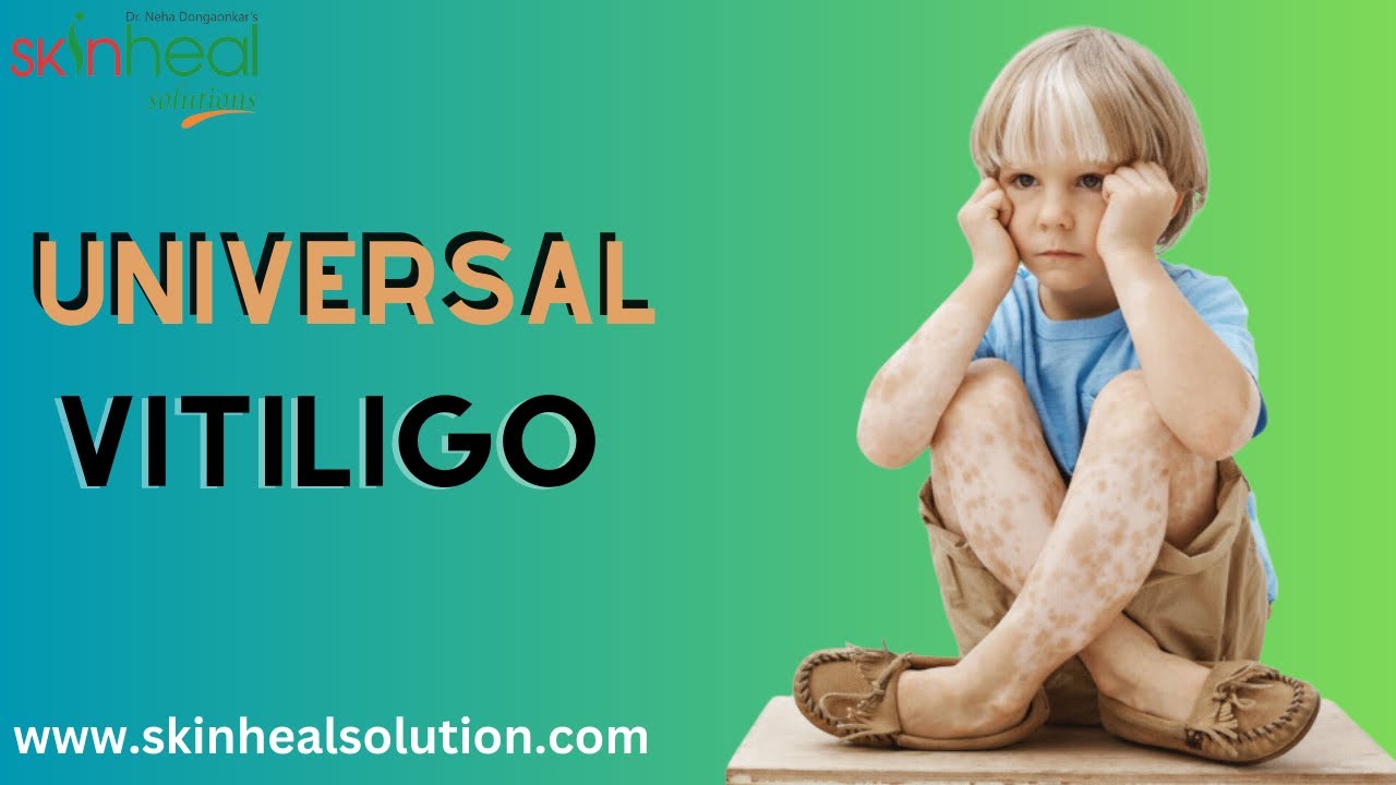 Universal Vitiligo Can Be Cure || Dr. Neha Dongaonkar