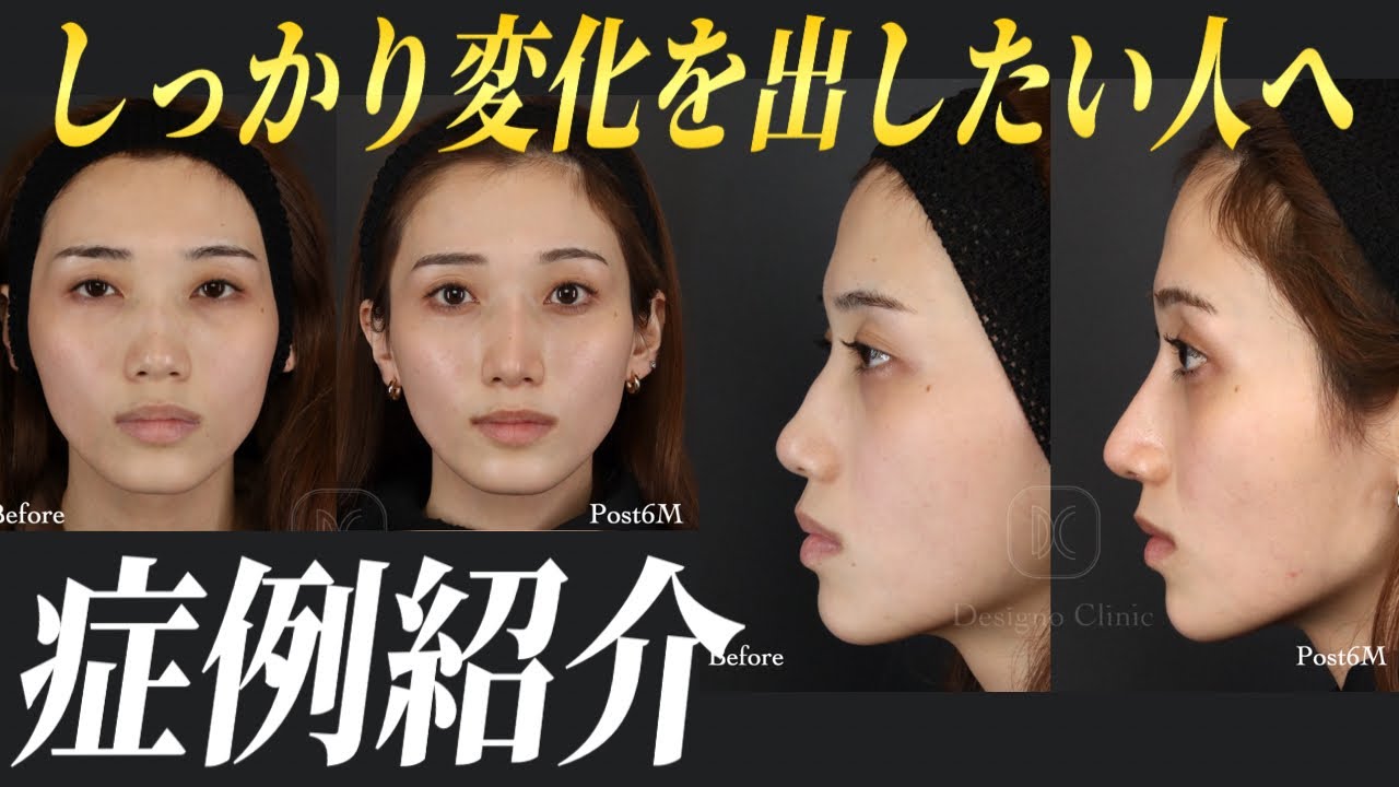 【鼻整形】”しっかり変化を出したい人向け”の手術メニュー&症例写真を紹介！ビフォーアフターやダウンタイム、術後の過ごし方まで【鼻柱下降/鼻中隔延長/鼻尖形成/軟骨移植】