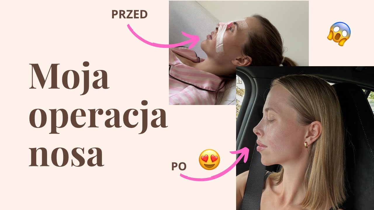 Operacja nosa: powód, cena, przebieg operacji, efekty przed i po!