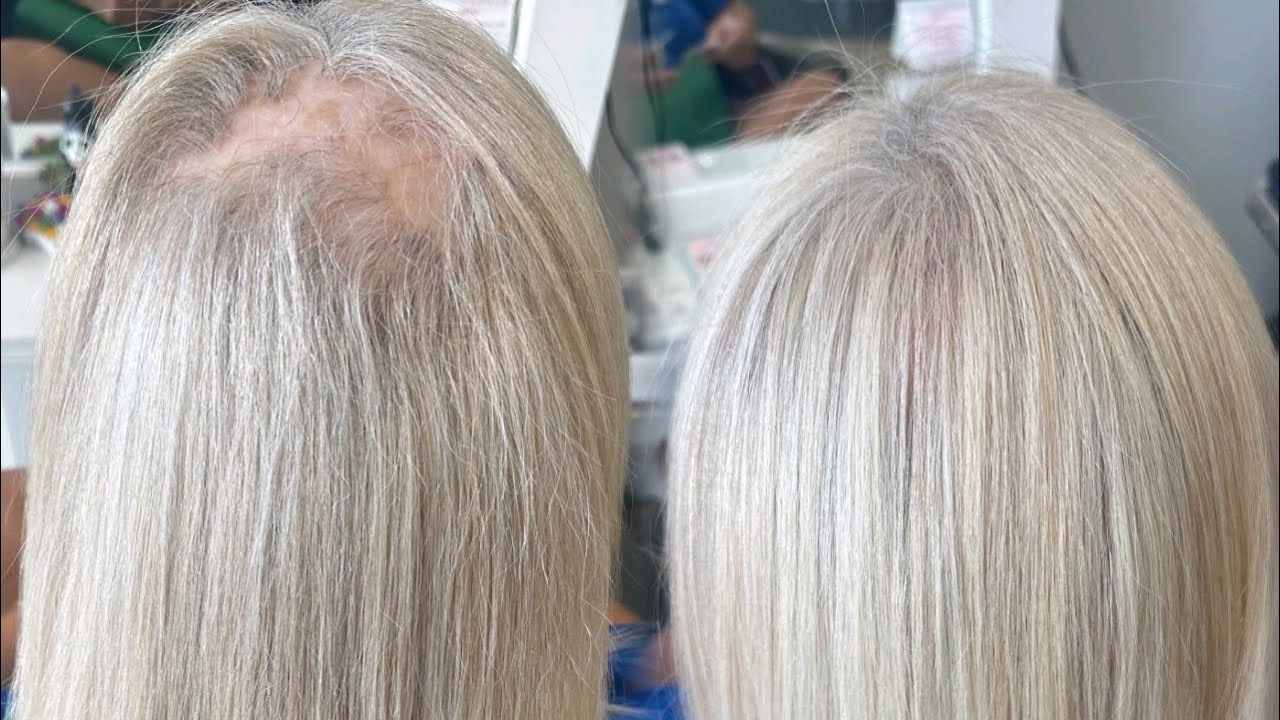 V light hair extension| alopecia hair thinning/ balding | hair extension transformation