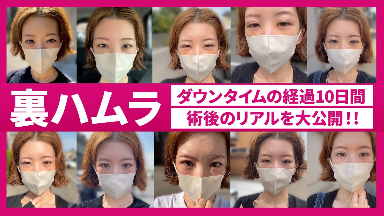 【クマ取り】裏ハムラのダウンタイム10日間｜術後のリアルな経過を解説