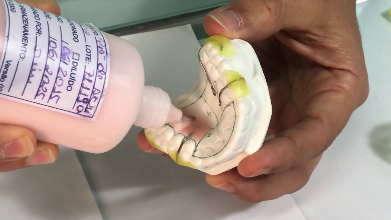 Acrilização da Placa Ortodôntica