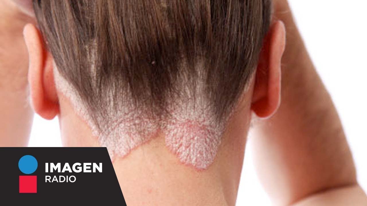 ¿Qué es y cómo se trata la psoriasis? / Bien y Saludable