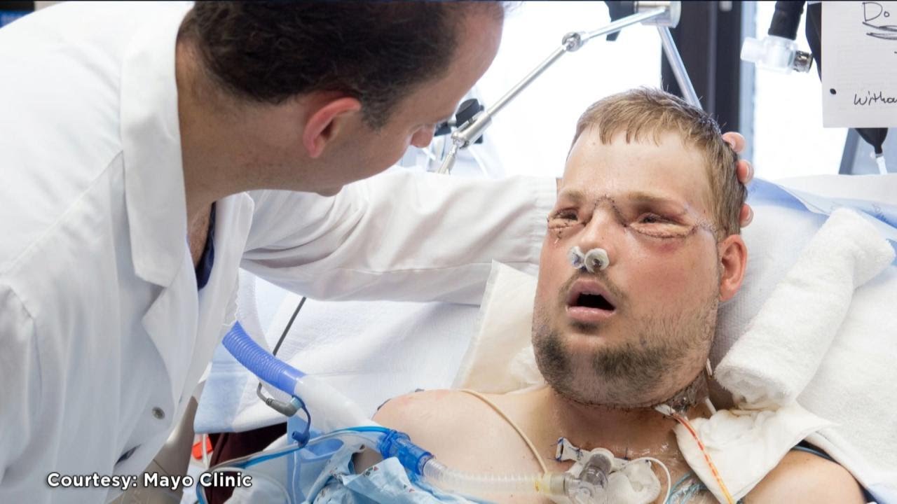 Exclusive: How the Groundbreaking Face Transplant Was Accomplished