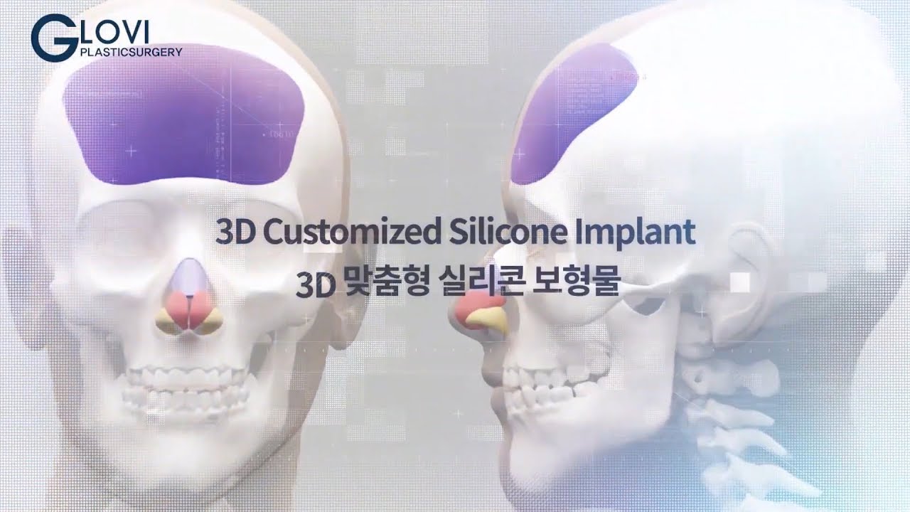 3D Fitting Nose Custom implants by  GLOVI plastic surgery