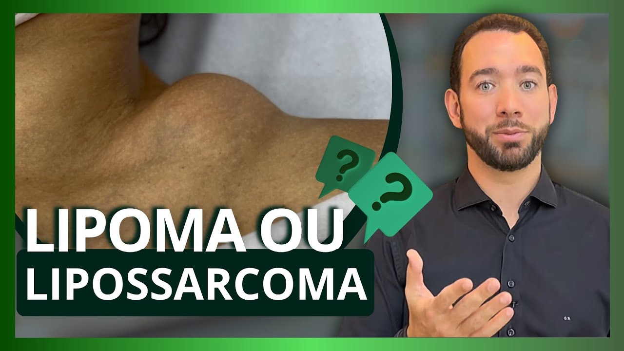LIPOMA PODE VIRAR CÂNCER? Diferenças entre o lipoma e o lipossarcoma! | Dr. Gabriel Renato