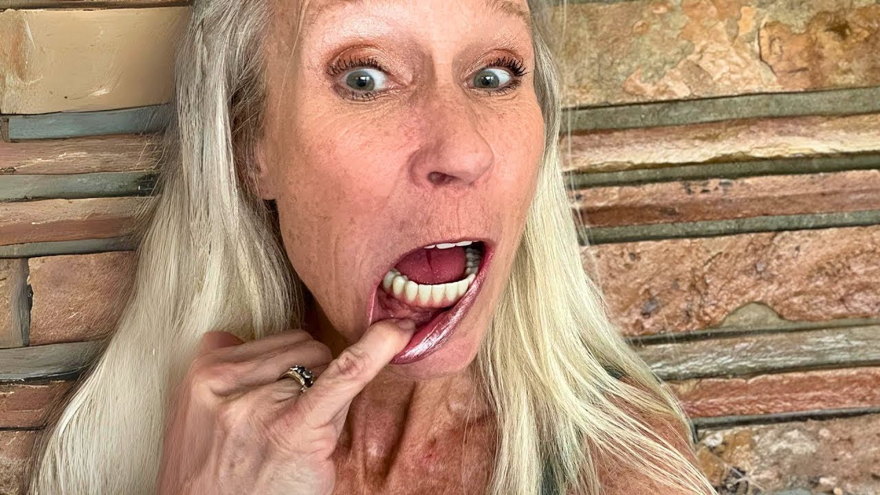 The Good And Bad Of My Dental Implants After 3 Years!