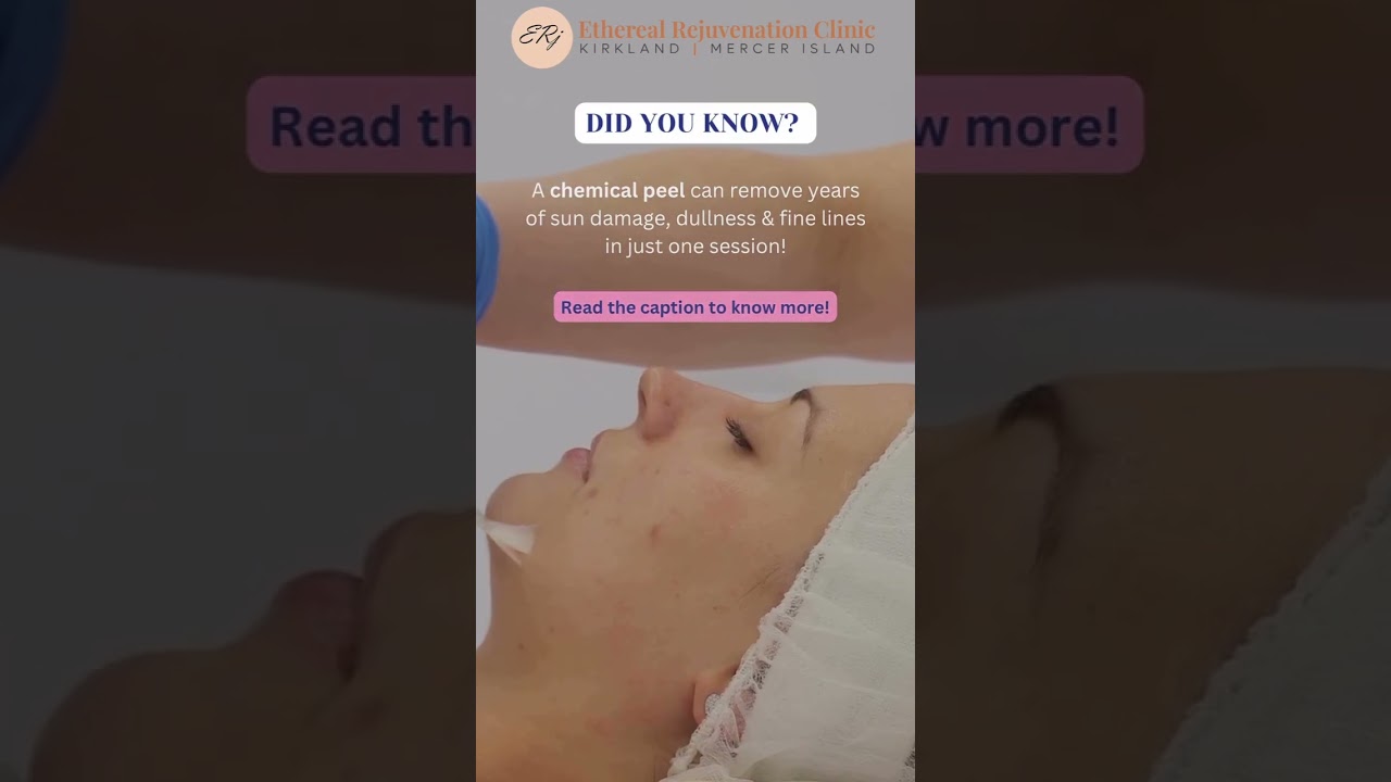 ✨ Chemical Peel Transformation | Erase Sun Damage & Fine Lines in Just One Session! 🌞💆‍♀️