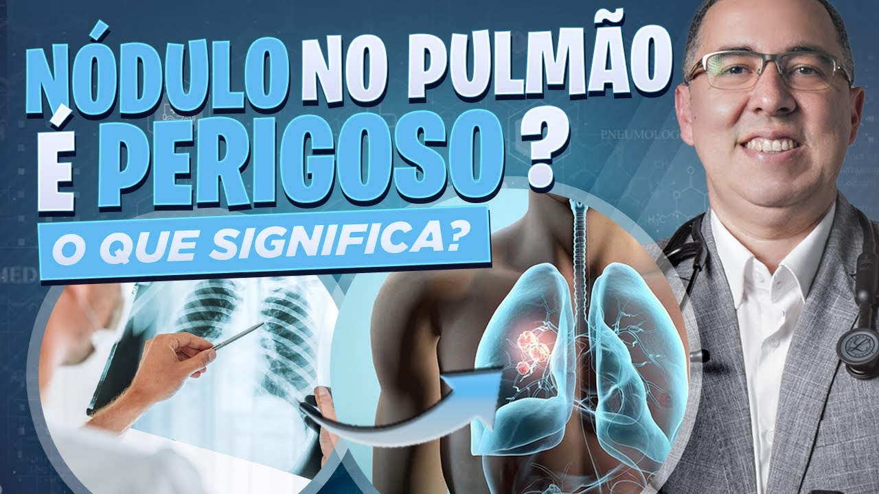 NÓDULO NO PULMÃO é preocupante e pode ser CÂNCER? Médico Pneumologista responde