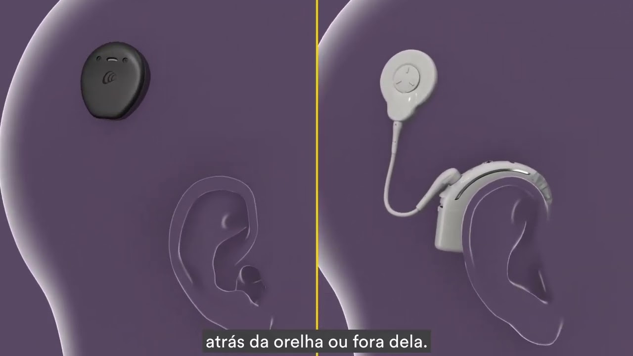 Como funciona o Sistema Cochlear™ Nucleus®