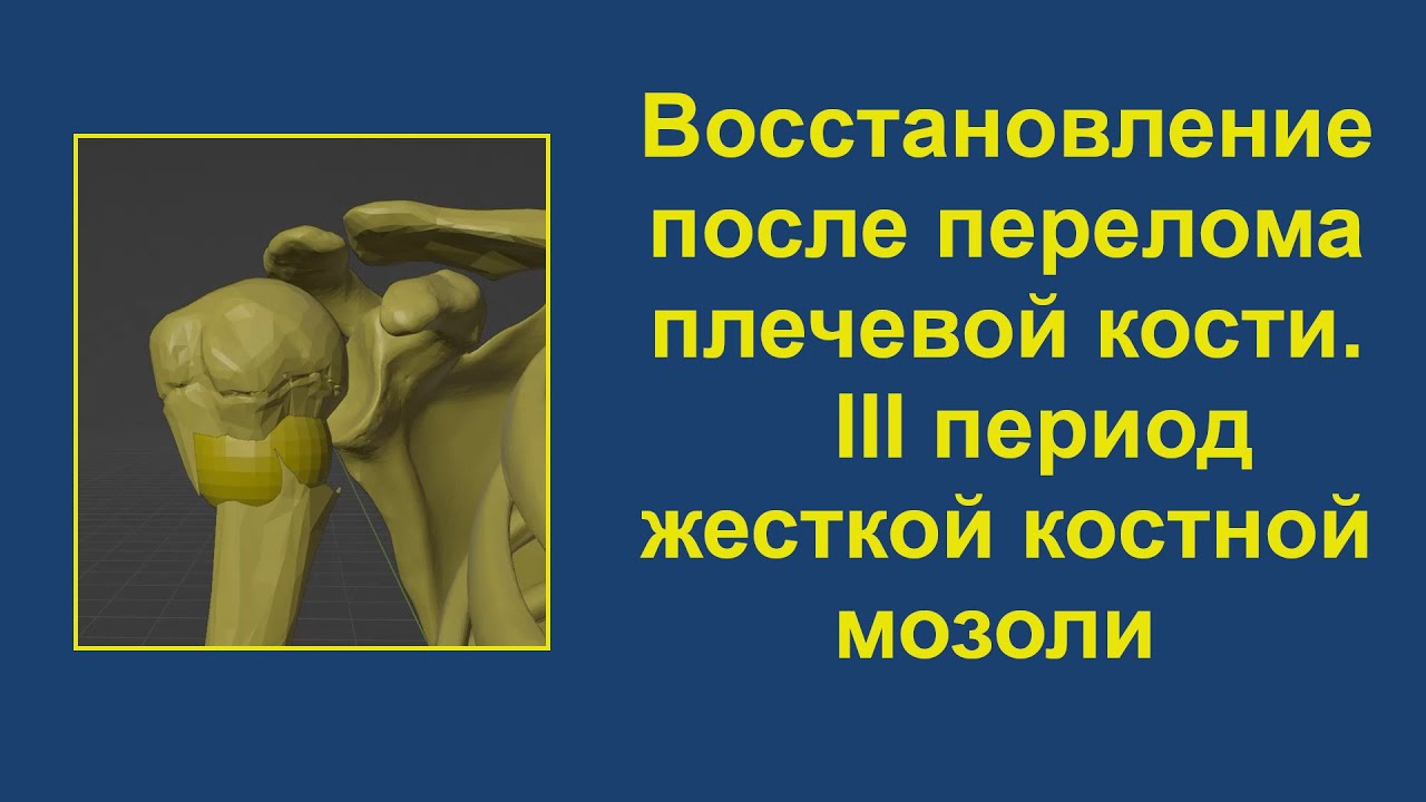 3. Восстановление после перелома верхней трети плечевой кости. Период жесткой костной мозоли.