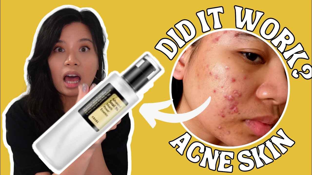1 YEAR OF COSRX ADVANCED SNAIL MUCIN POWER ESSENCE HONEST REVIEW | ACNE SKINCARE | sensitive skin
