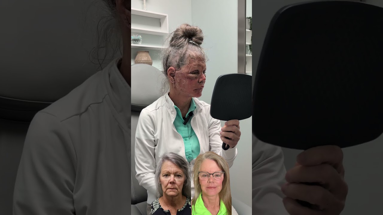 24 Hours Post-Op: Unwrapping (Deep Plane Facelift, Neck Lift, Lip Lift, Upper Blepharoplasty)