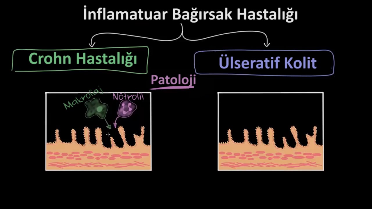 İnflamatuar Bağırsak Hastalığı Epidemiyoloji ve Patolojisi (Fen Bilimleri)(Sağlık ve Tıp)