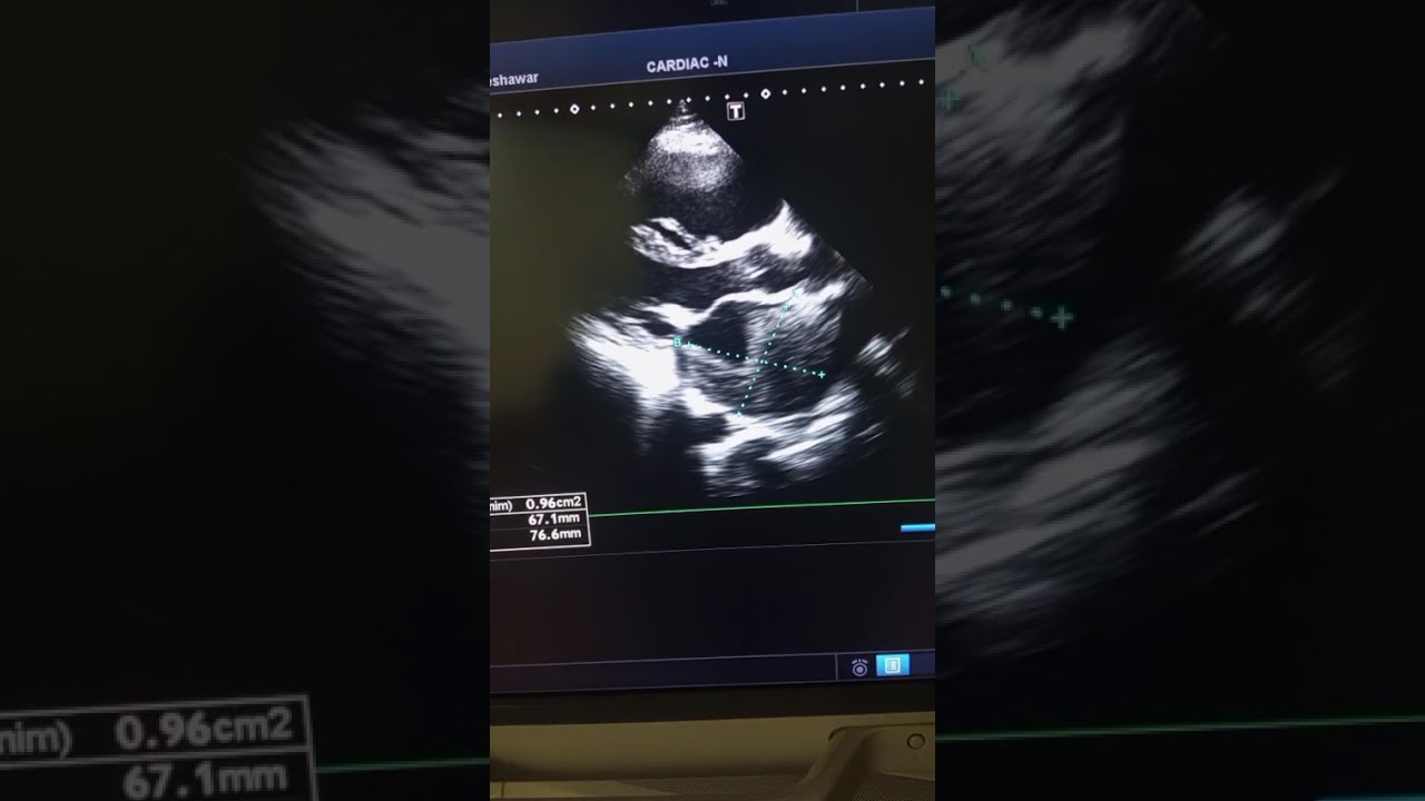 Mitral Stenosis | MS | LA clot | Plannimetry 