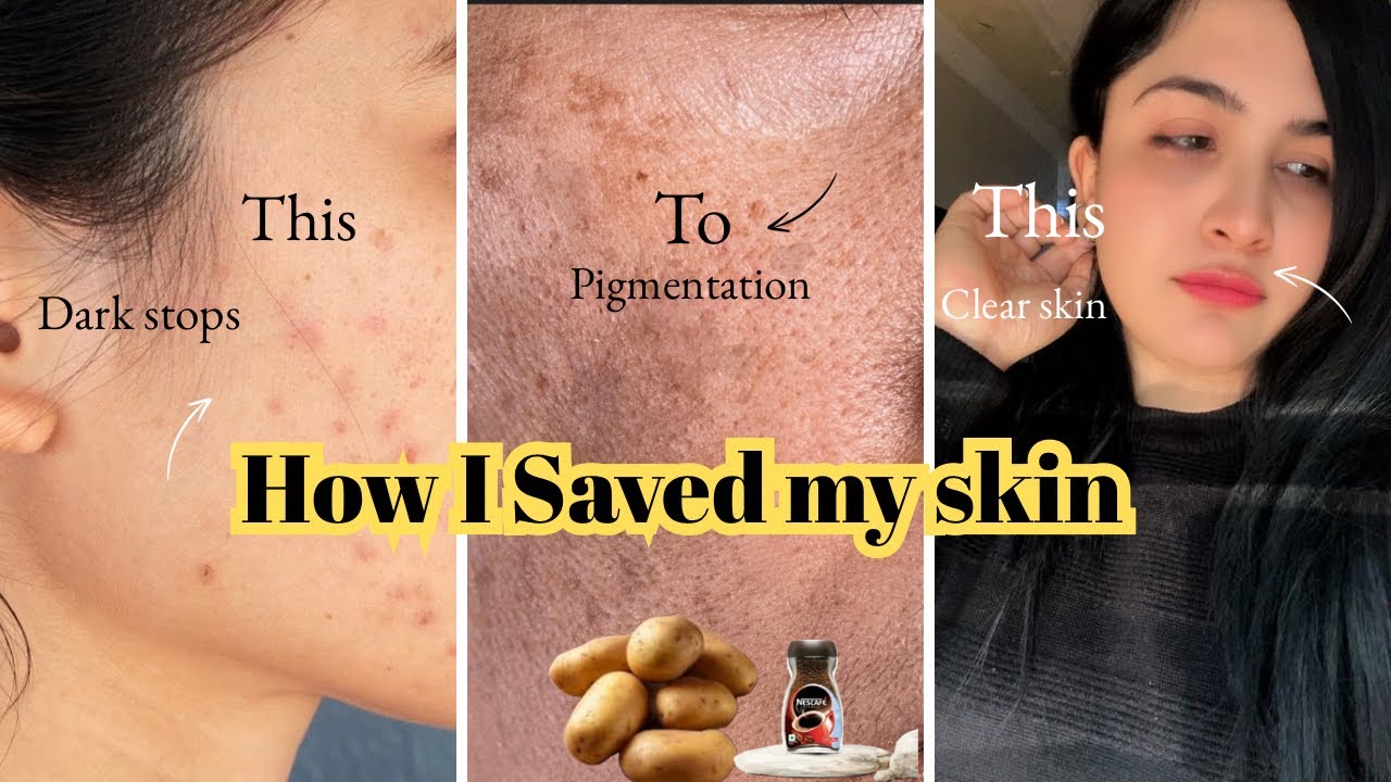Coffee & Patatoes Mask 🥔|| My Skin Was a Mess... Until I Tried This!