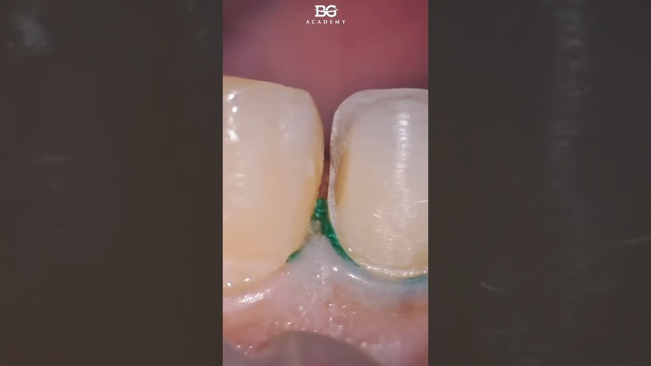 Prep for veneers, type 2. #veneers #preparation #veneerprep
