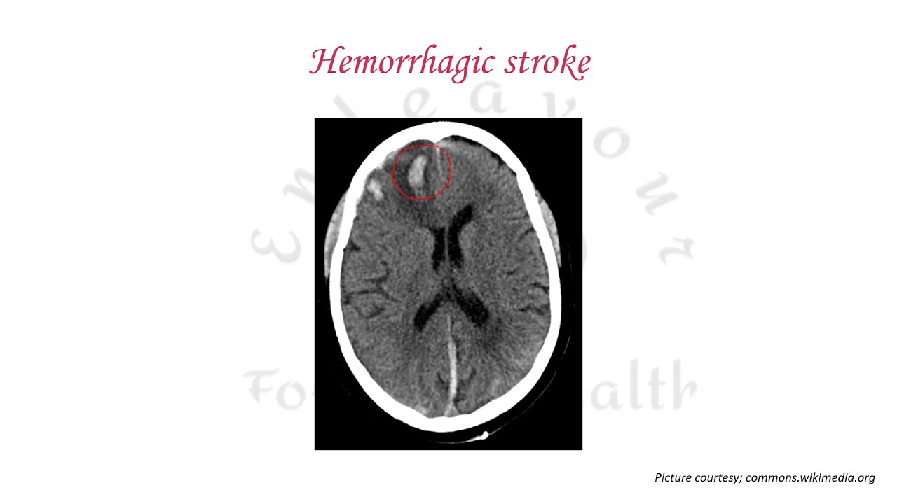 Pediatric Stroke/ASA guidelines 2019/AHA guidelines 2019/Stroke in children