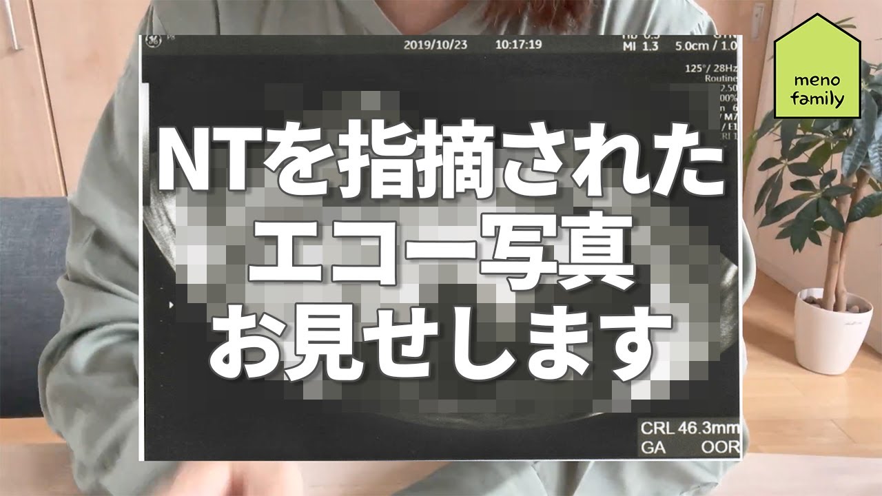 NT(胎児浮腫)を指摘されたエコー写真お見せします