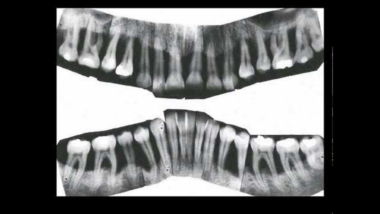 Paradentite - Periodontosi