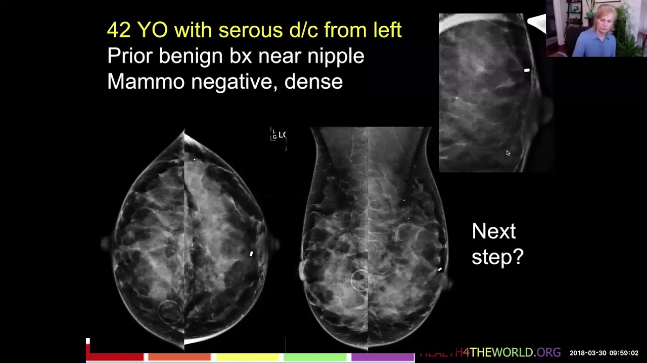 Imaging of Symptomatic Breast - Part 3 : Nipple Discharge | Health4TheWorld Academy