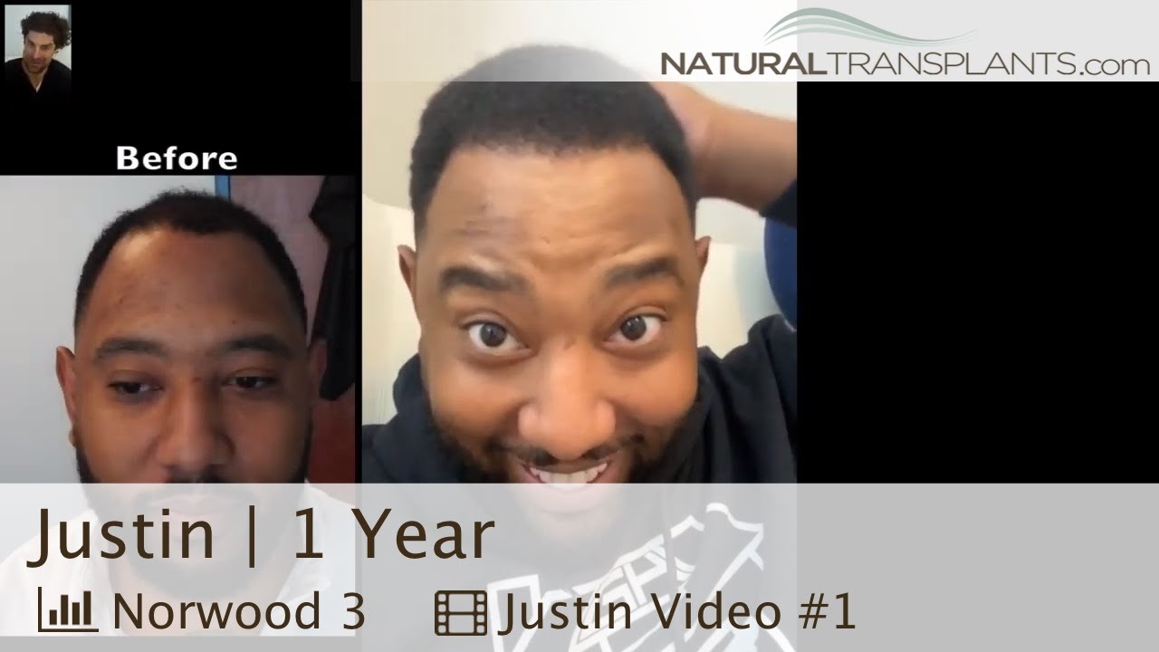 1-Year African American Male Hair Transplant Results | Dr. Matt Huebner (Justin)