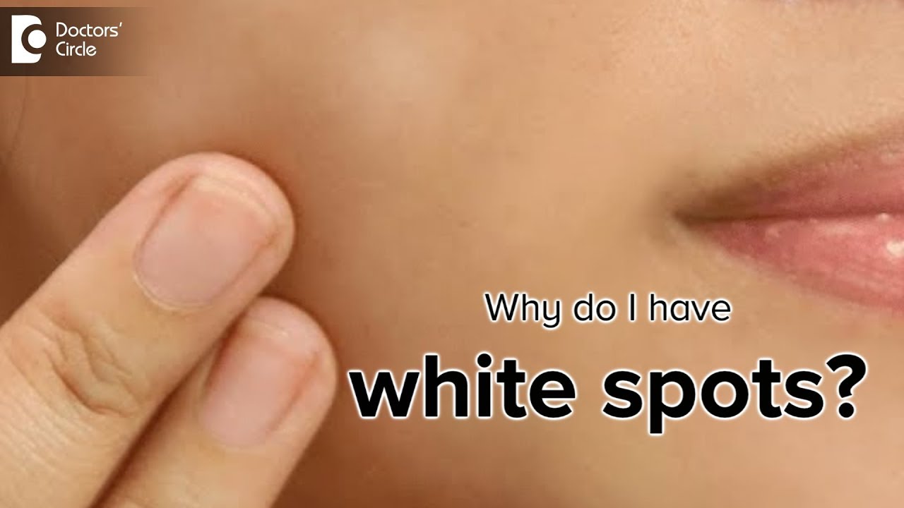What is the cause of white spots on the skin? - Dr. Rasya Dixit