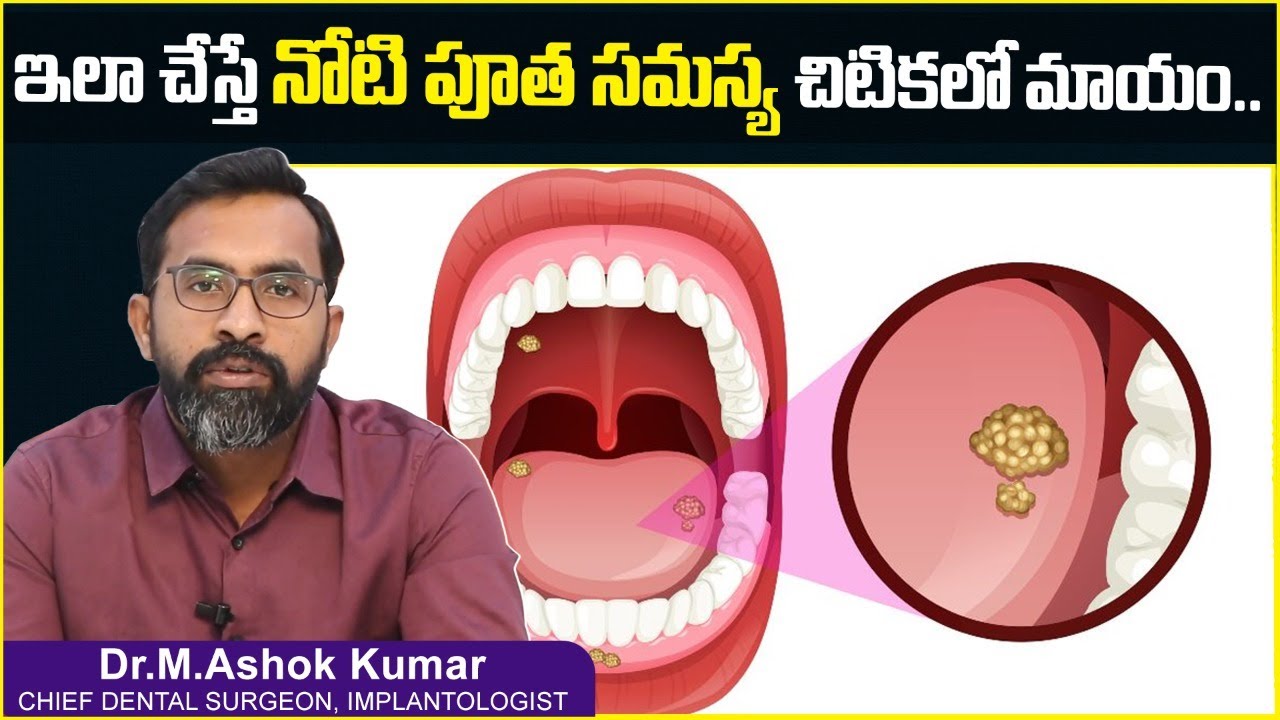 నోటి పూత సమస్య?| How to Get Rid of Mouth Ulcers | Home Remedies For Mouth Ulcers | Eledent Hospitals