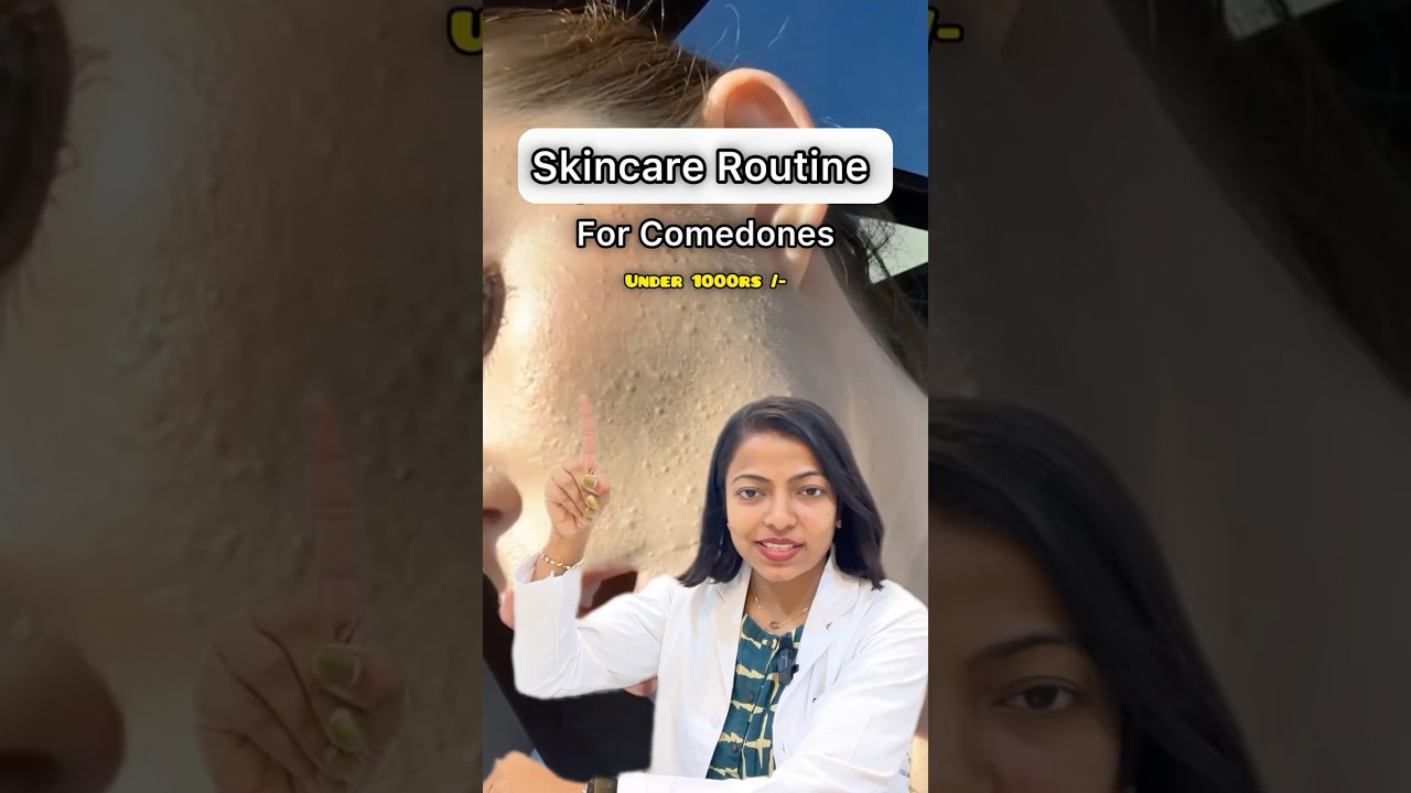 Skincare Routine for Comedonal Acne #comedones  #acne #skincareroutine