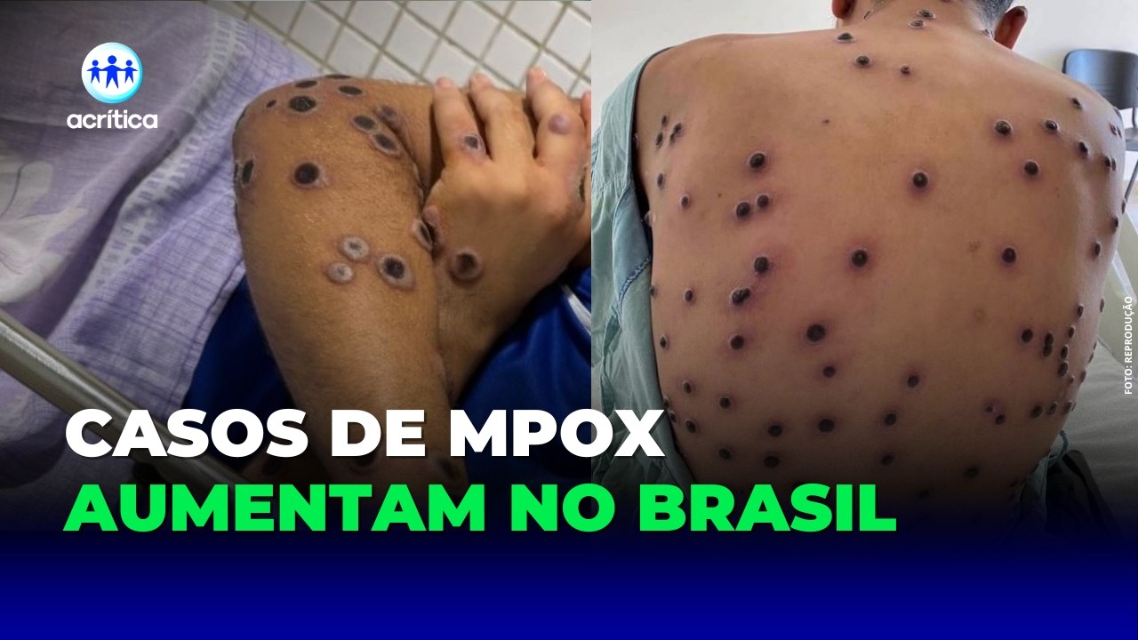MPOX AVANÇA: BRASIL REGISTRA AUMENTO DE CASOS